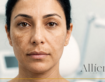 What Is Melasma? Causes, Types and How to Treat It Effectively